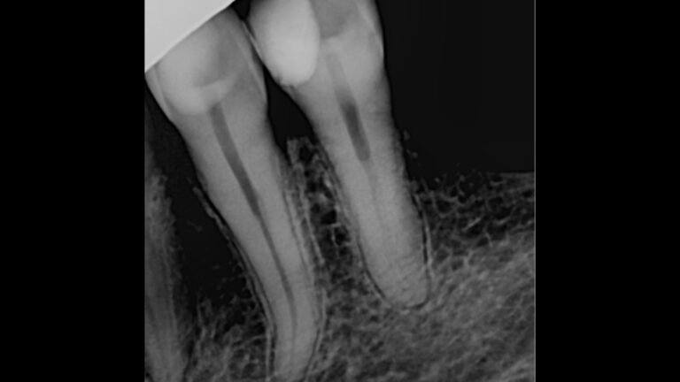 FOTOS WEB-5-endo-antes-min